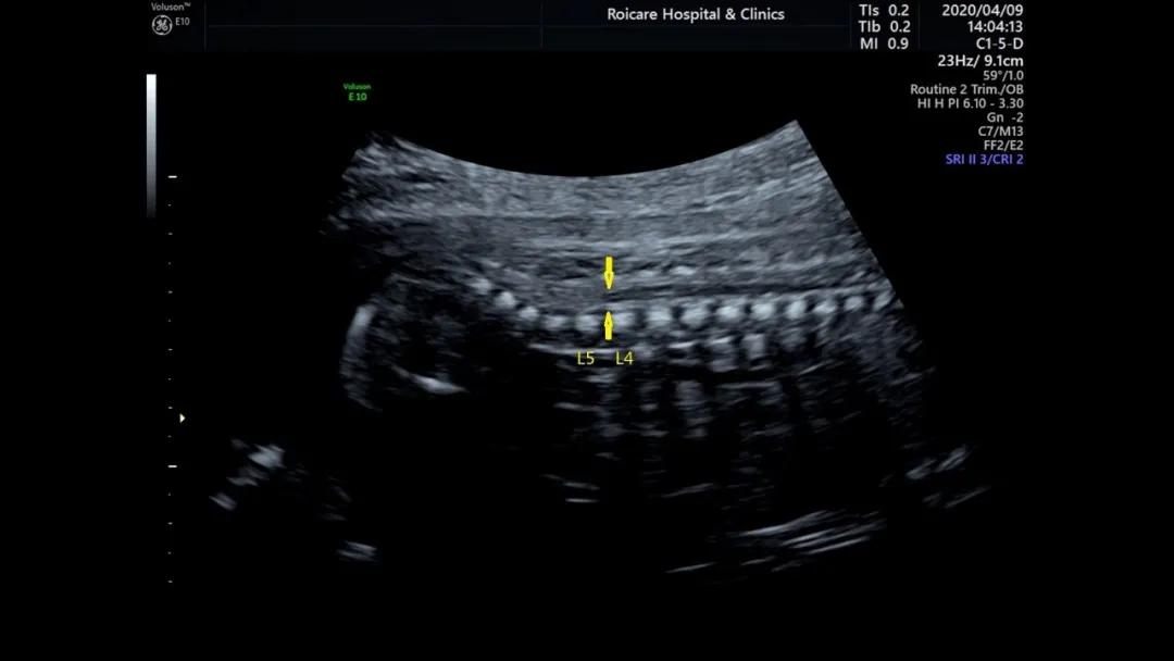 胎儿期发现脊髓圆锥位置低的临床指导