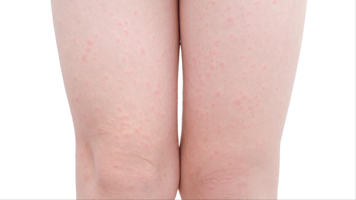 天生就有的鸡皮肤如何去除,鸡皮肤的人怎么去掉鸡皮肤