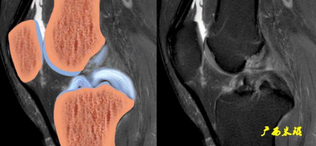 交叉韧带损伤的mr表现,后交叉韧带损伤的诊断实验