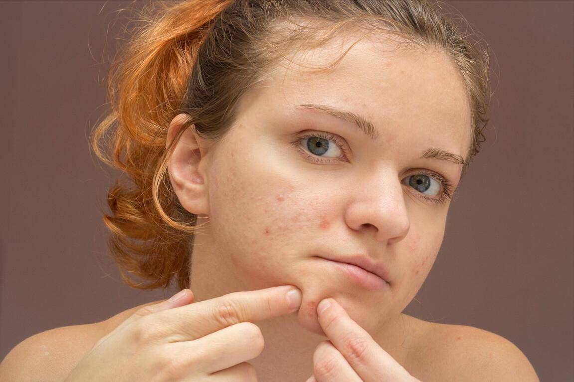 怎么去除痘印和黑头,怎么去除痘印