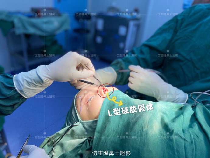 骨粉注射隆鼻皮肤变薄怎么办,线雕隆鼻会引起鼻挛缩吗