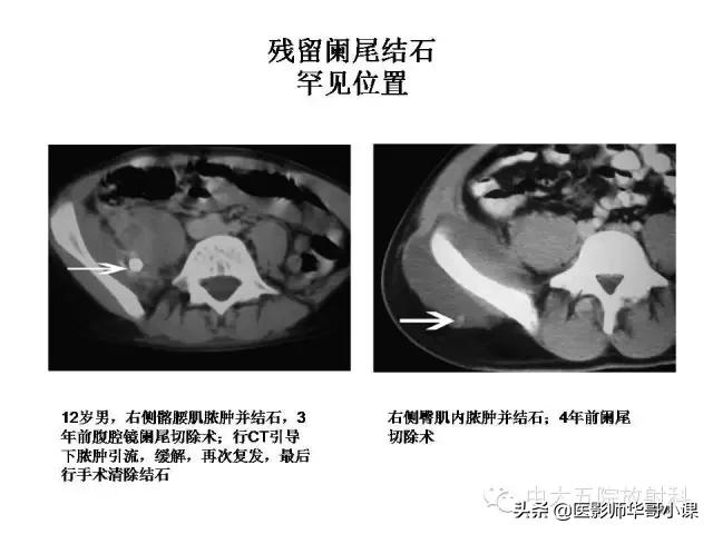 阑尾炎课件,阑尾炎的超声课件