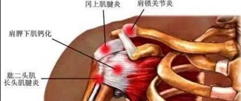 弧刃针一次搞定腱鞘炎,腱鞘炎手腕疼一招搞定