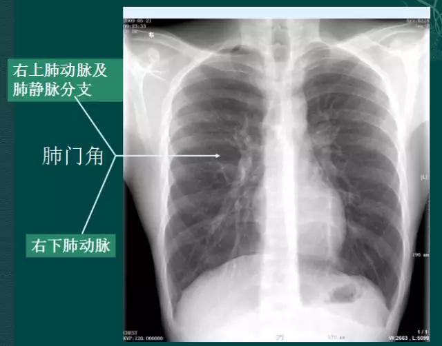 拿到胸部ct我们该怎么看,怎样看懂胸片报告单