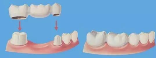 为什么做了烤瓷牙的人都后悔,烤瓷牙套弄上后悔了该怎么办