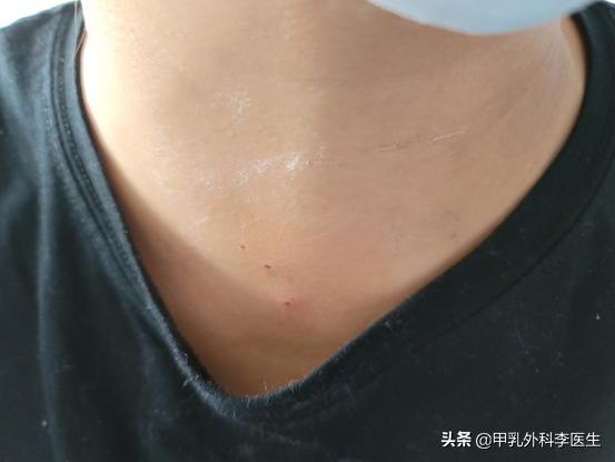 消融术治疗甲状腺结节要多久能好,甲状腺开刀还是消融术