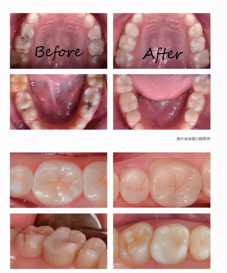 椅子修复工艺视频,椅旁修复技术安全性