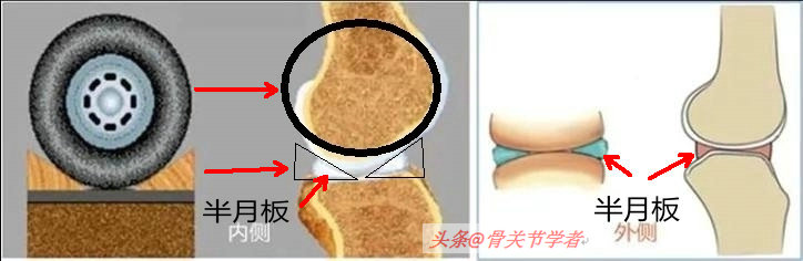 磁共振检查半月板损伤有误诊率吗,半月板磁共振会不会有误诊