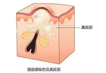 长痘不要惊慌教你自救小妙招,长痘怎么正确处理