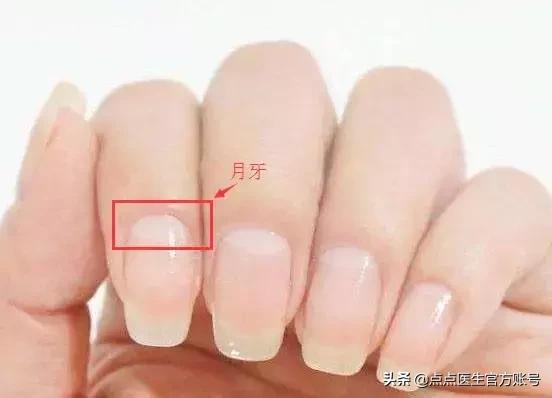 指甲上有月牙少是不健康的表现吗,指甲月牙少是身体不健康的表现吗