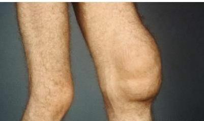 滑膜炎导致的膝盖积液用不用抽取,关节炎有积液属于滑膜炎类型吗