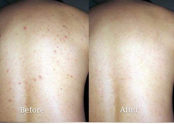 身上的螨虫会粘在衣服上吗,身上螨虫太多身体会烂么