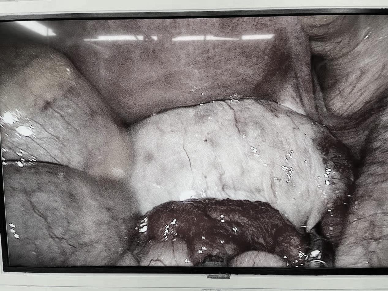 【技术】妇科无痕腔镜手术在南昌大学二附院妇产科成熟开展