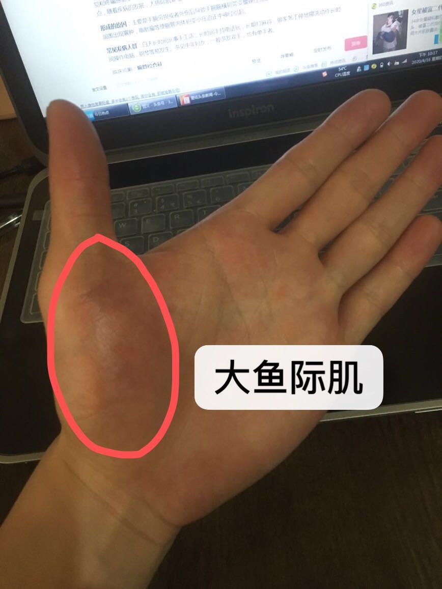 早上醒来双手发麻活动一会就好了,晚上睡觉双手发麻活动一下又好了