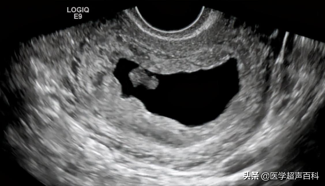 超声提示:胚胎停止发育的诊断、诱因及预防,这些知识你了解多少