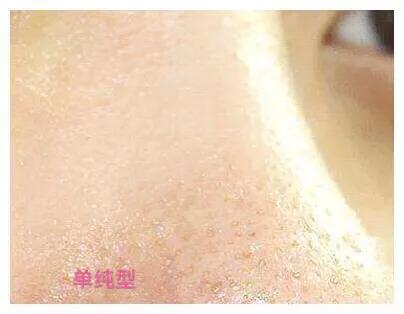 怎样缩小毛孔效果最好的方法,如何缩小鼻子毛孔和处理黑头