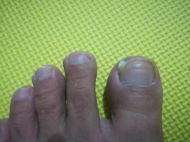 摆脱甲沟炎的痛苦之后的感想,甲沟炎的亲身经历