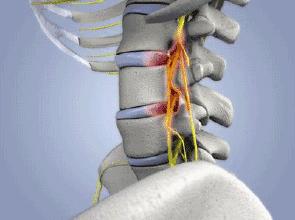 骨科怎样治疗颈椎病引起头痛头晕,骨科什么病会导致头晕