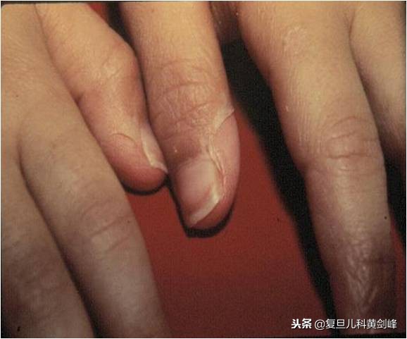 发热白细胞高达25什么原因,发热白细胞高c反应蛋白高