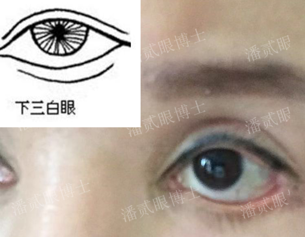 下三白眼长大后会改善吗,下三白眼的人如何手术矫正