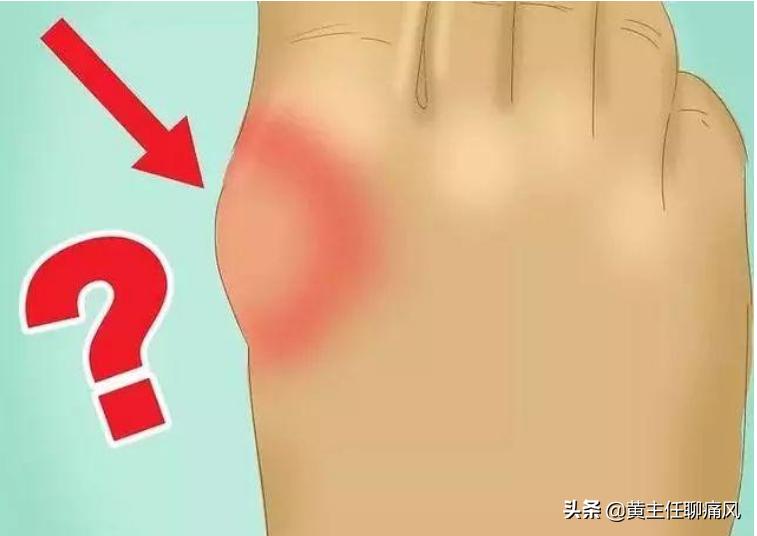 你一定不知道的痛风误区快来瞧瞧,必须了解的十大痛风常识