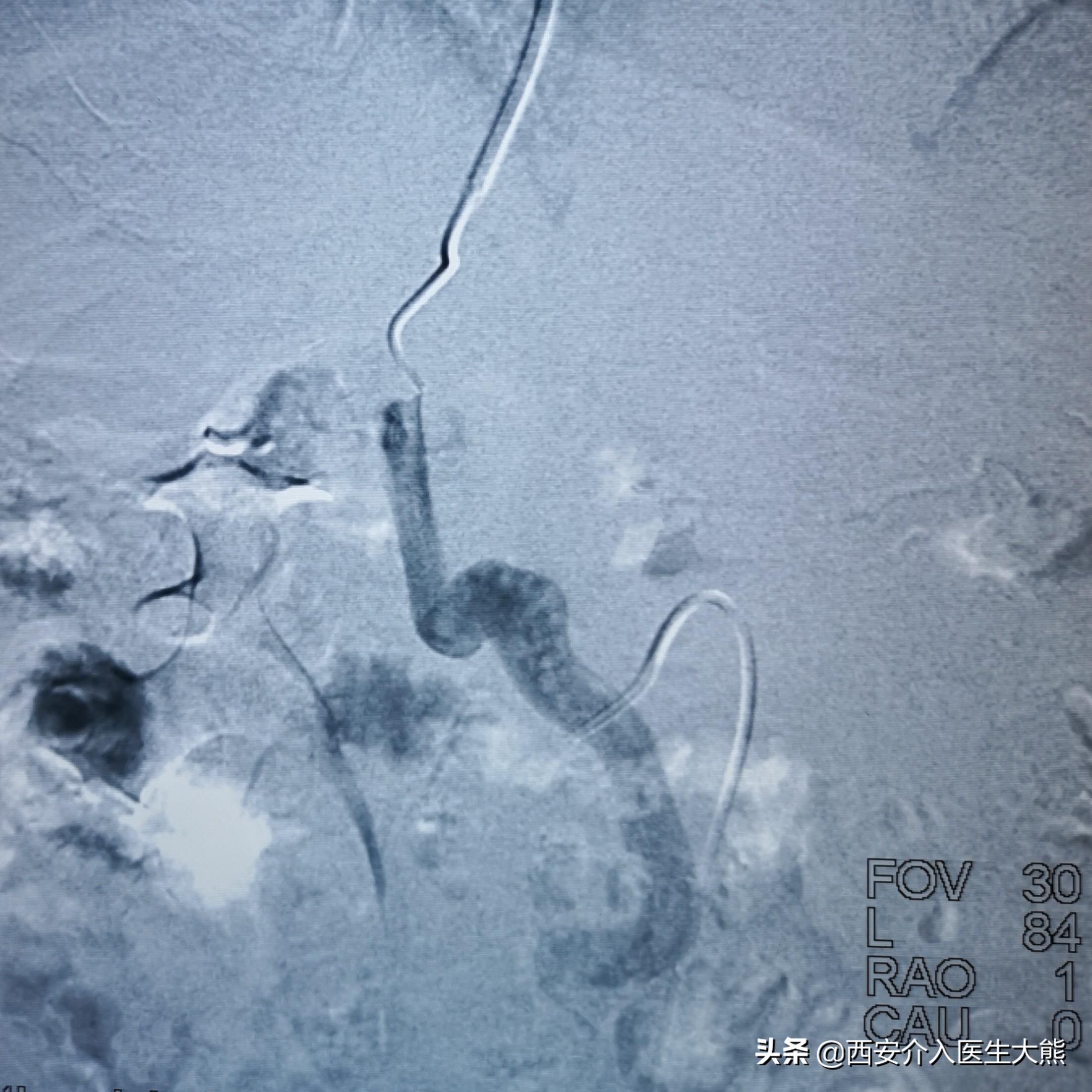 肝硬化消化道出血的病例护理讨论,肝硬化引起的消化道出血如何治疗