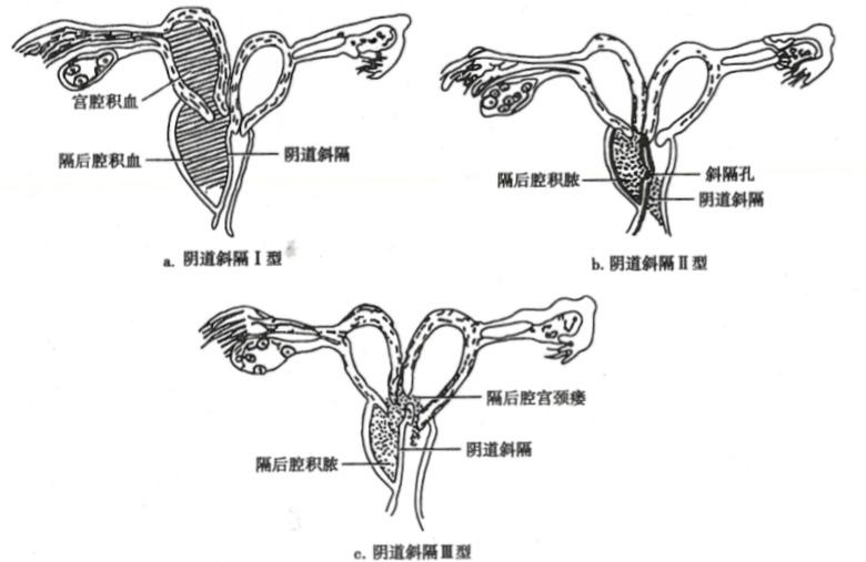 突然开始痛经可能是什么造成,痛经是子宫不健康吗