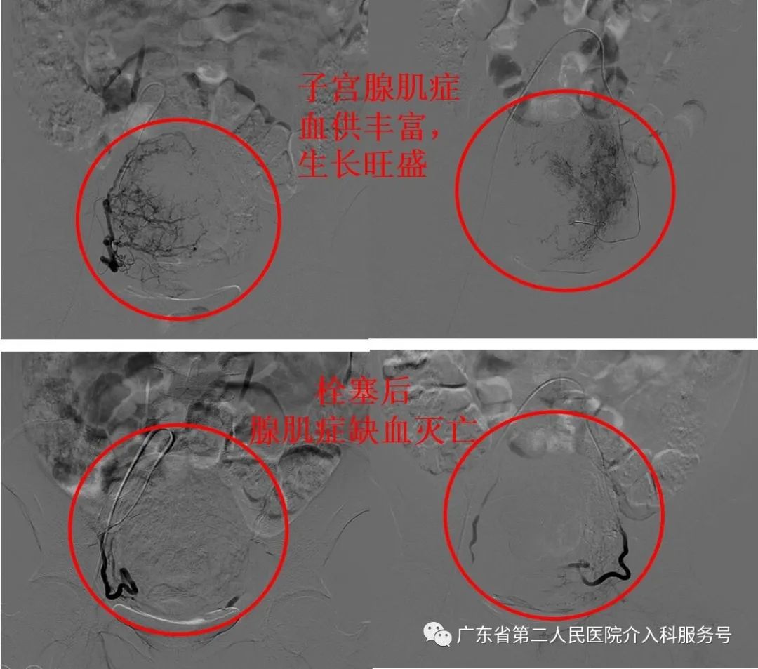 49岁腺肌症痛经月经量大怎样治疗,子宫腺肌症子宫增大痛经不明显