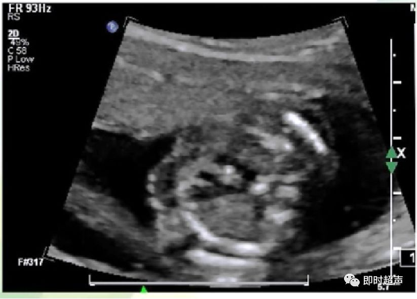 胎儿心脏三种血管关系模式图,25周的胎儿心脏弓切面多少正常