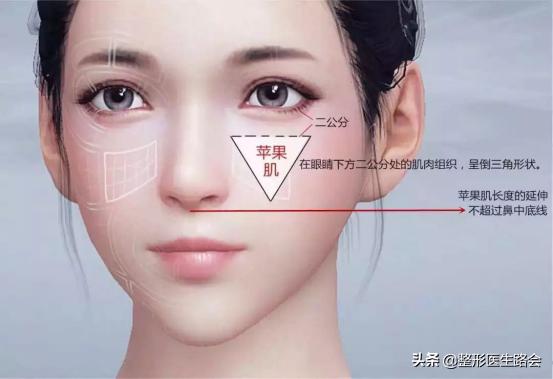 颧骨磨骨苹果肌下垂如何修复,如何判断是苹果肌还是高颧骨