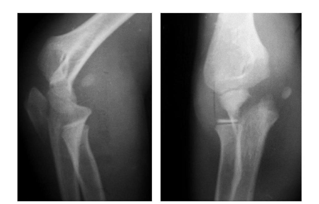 青少年肘部损伤最常见的是,肘部桡神经损伤的临床表现