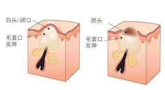 去闭口精华教程,干货亲测最强去闭口攻略