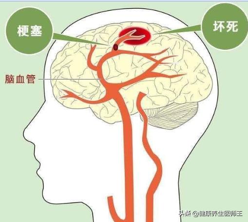 生命健康有哪些方面,临床症状脑血栓形成