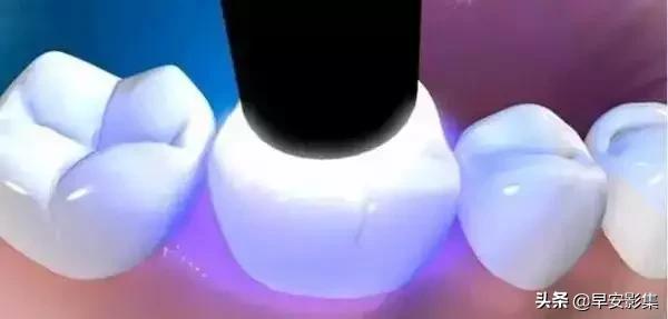 牙医补牙有区别吗,什么叫补牙什么叫种牙