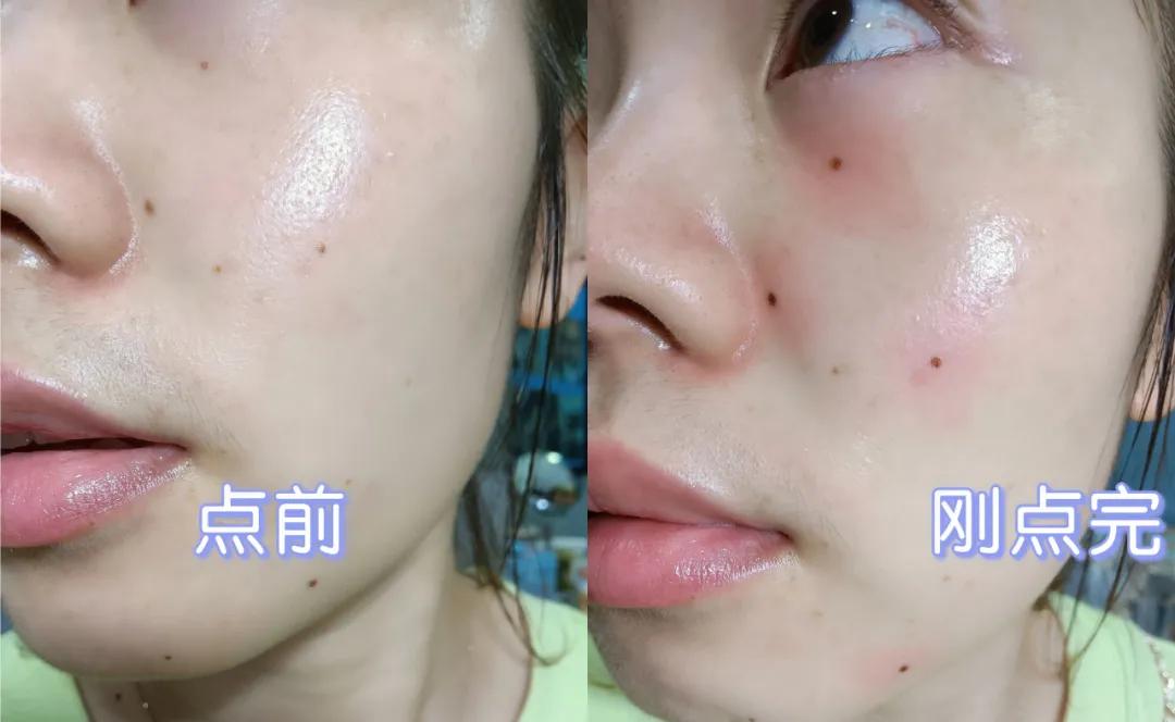 痣多适合什么点痣方法,点痣小妙招一秒点好一个美人痣