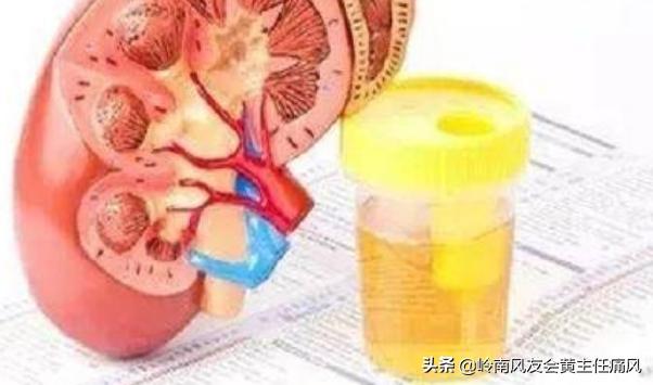 痛风患肾结石的概率高吗,痛风患者患肾结石的几率高吗