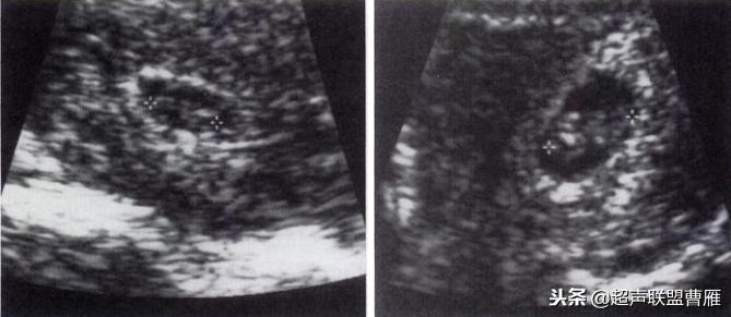 3毫米卵黄囊未见胎芽正常么,40多天的卵黄囊