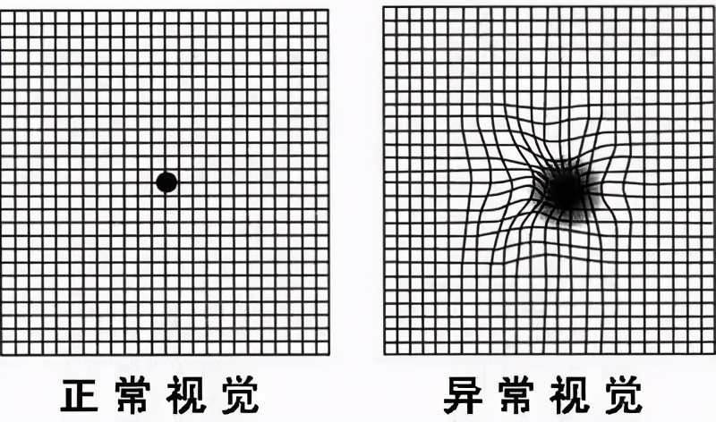 糖尿病眼底黄斑水肿打什么针好,糖尿病视网膜病变引起的黄斑水肿