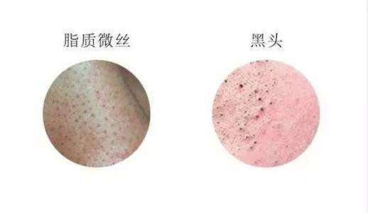 怎么才能真正有效去黑头,怎么辨别去黑头药物的真假