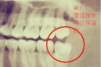 长智齿疼必须拔掉吗,长智齿有点痛需要拔掉吗