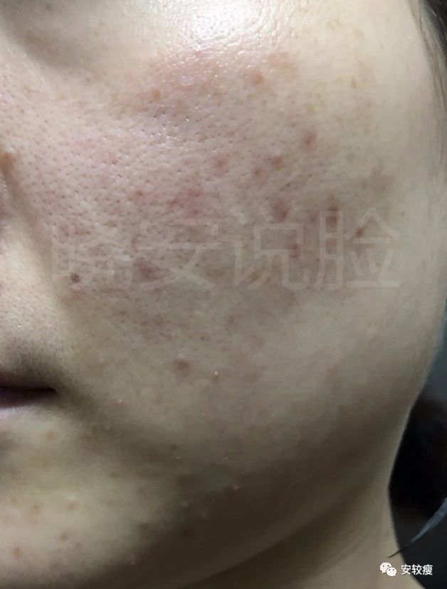 外油内干敏感痘肌怎么护肤,30岁油皮痘痘敏感肌怎么改善