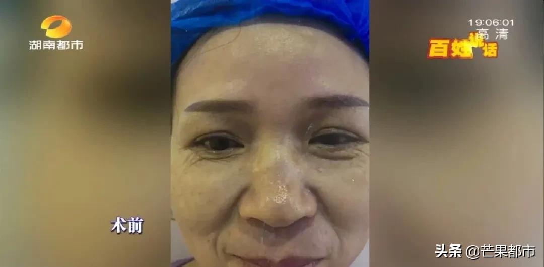 手术去除法令纹的效果到底怎么样,中医美容祛法令纹真的吗