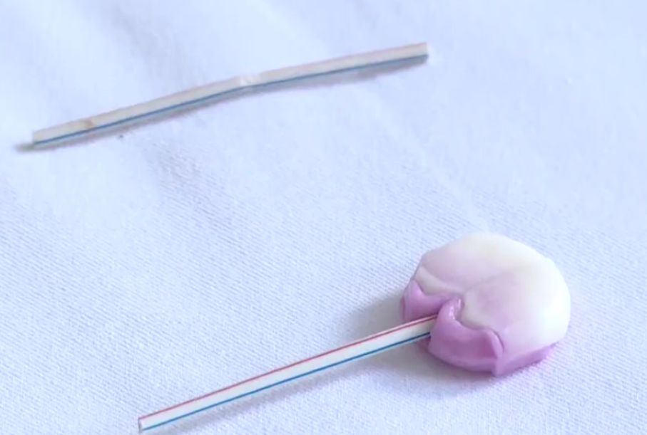 孩子误吞棒棒糖棍子反应,男童误吞2厘米钉子