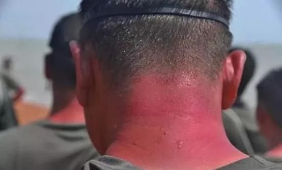 军训晒伤如何快速修复,军训中晒伤了怎么补救