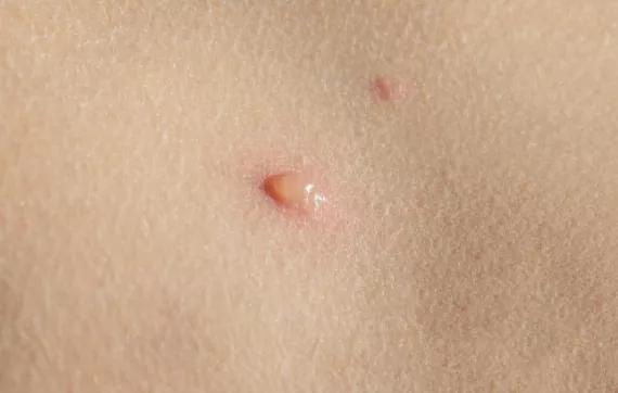 杭州70岁老伯下身长了20cm这东西,因“羞耻”不去医院