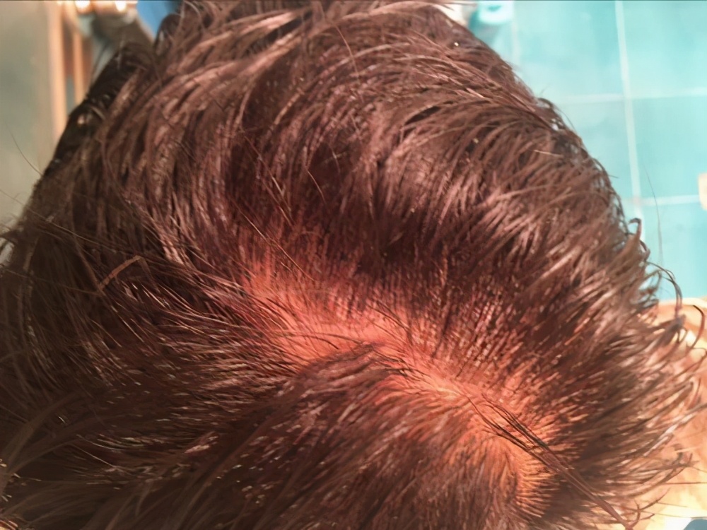 长期用硫磺皂洗身体的危害,江苏一女子坚持用硫磺皂水洗头发