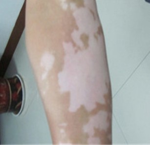 因为白癜风自卑,孩子得了白癜风父母很焦虑