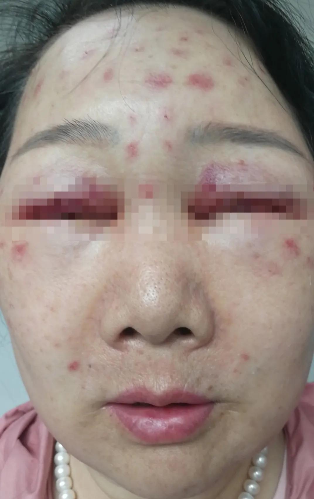 一次水光针相当于敷了1000次面膜,一次水光针等于10次补水