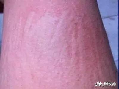 麻疹有什么中成药,常见人工荨麻疹的治疗方法有哪些