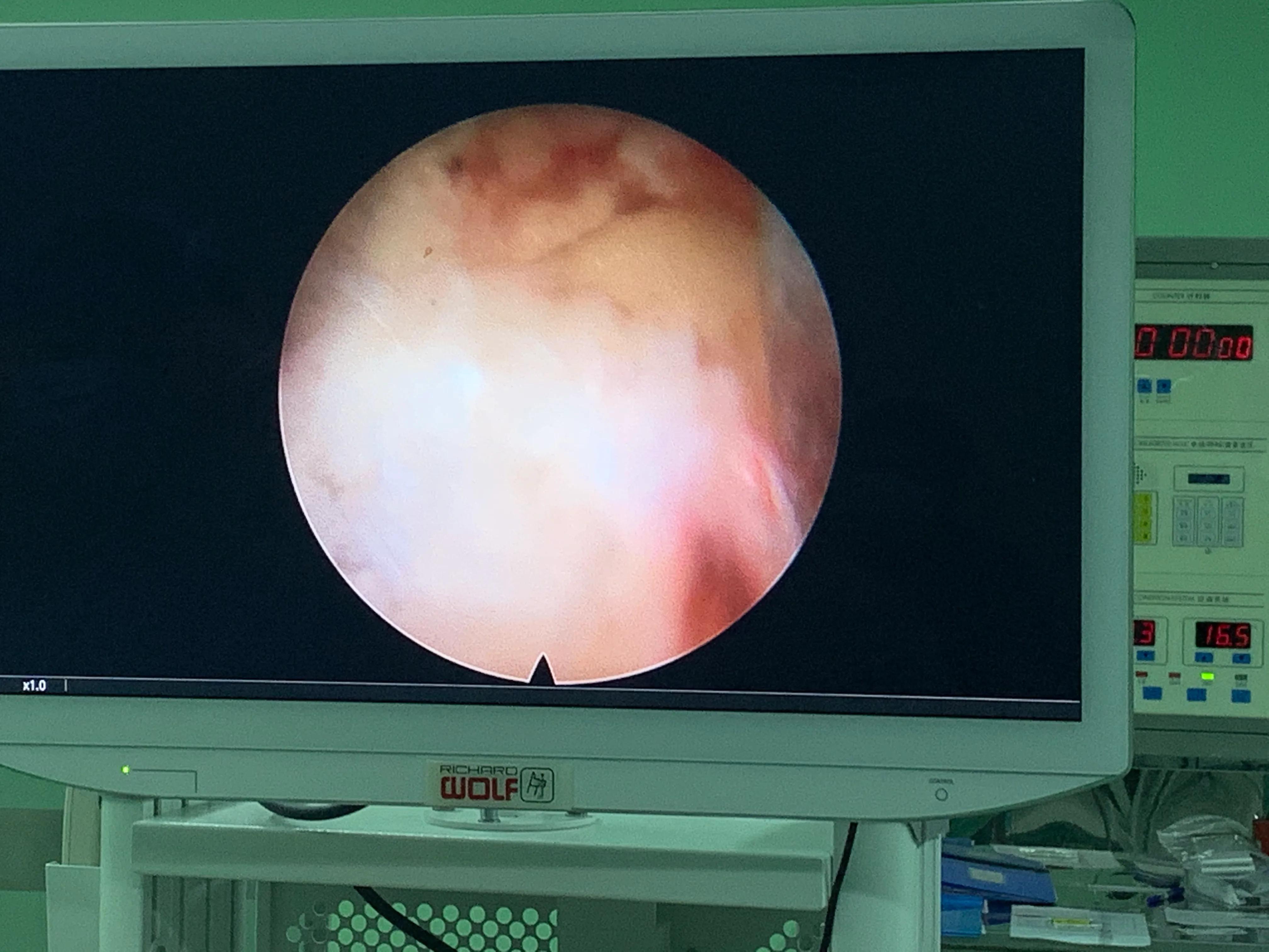 椎间孔镜术后腰痛症状多久消失,盘源性腰痛手术后易复发吗